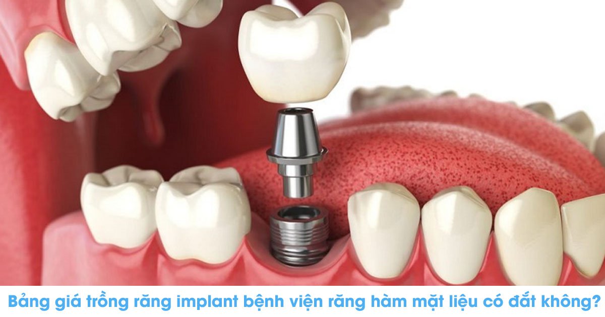 Bảng giá trồng răng implant bệnh viện răng hàm mặt liệu có đắt không?