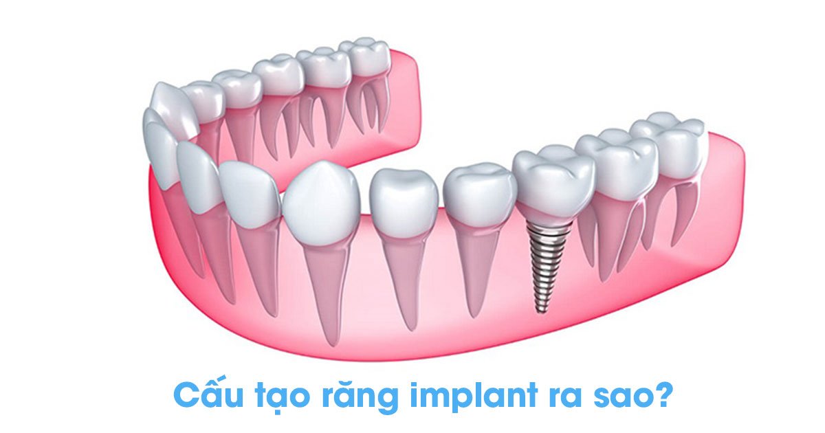 Cấu tạo răng implant ra sao?