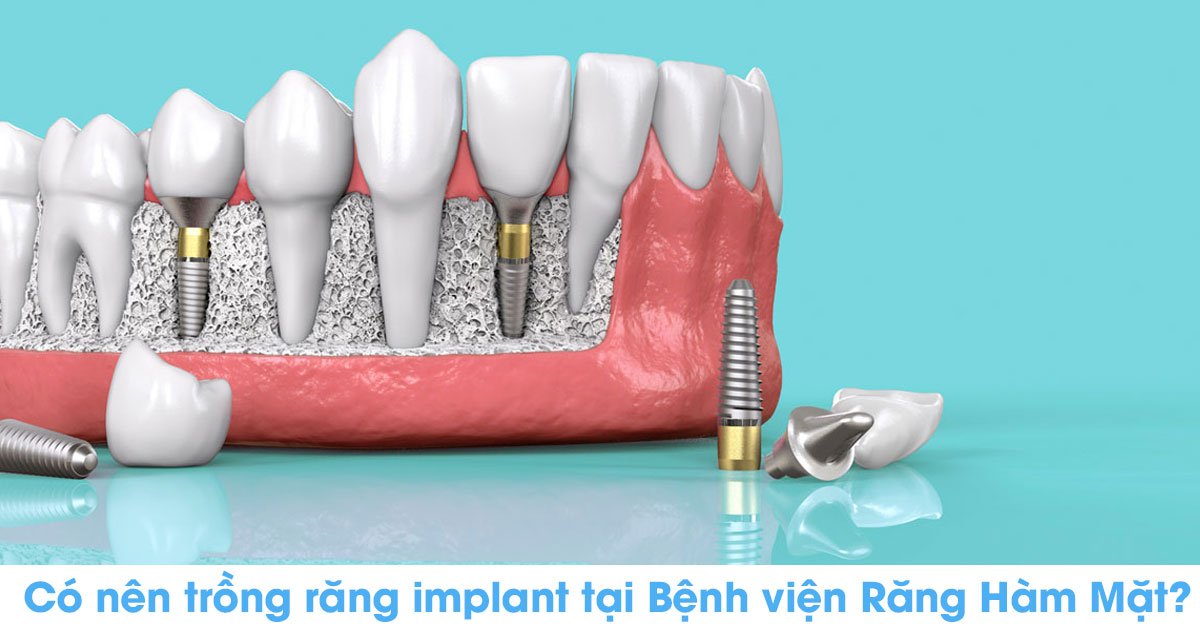 Có nên trồng răng implant tại bệnh viện răng hàm mặt?