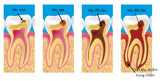Các giai đoạn sâu răng