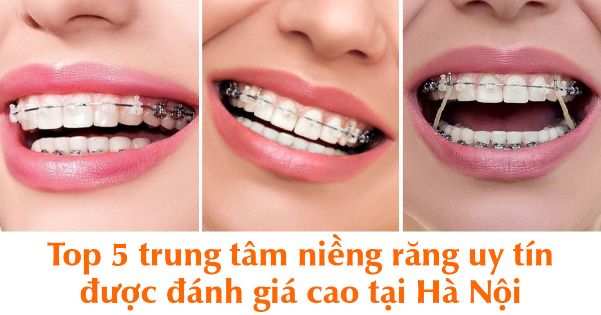 Top 5 trung tâm niềng răng uy tín được đánh giá cao tại hà nội