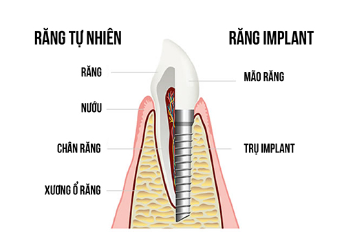 Rang implant