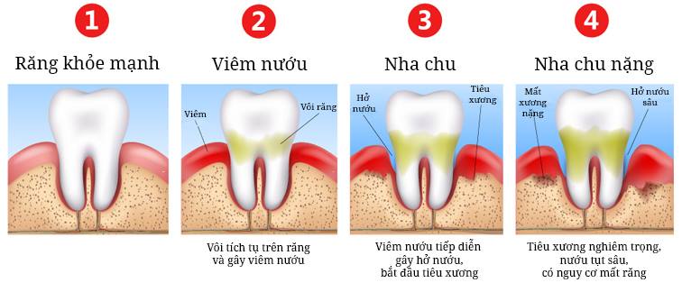Cao răng - viêm nướu