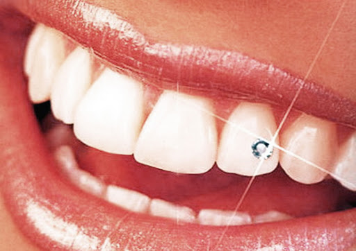 Làm sứ rồi có đính đá lên răng được không? 1 Dinh da len rang