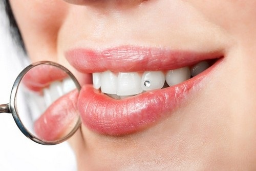 Gắn đá vào răng có tháo ra được không? 1 Gan da len rang