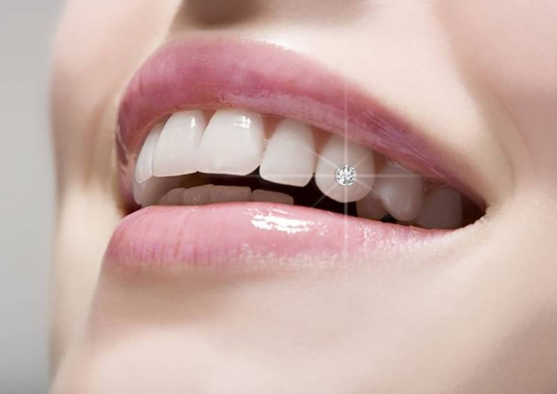 Đính đá lên răng để tăng tính thẩm mỹ cho nụ cười