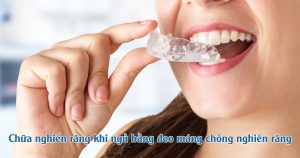 Chữa nghiến răng khi ngủ bằng đeo máng chống nghiến răng