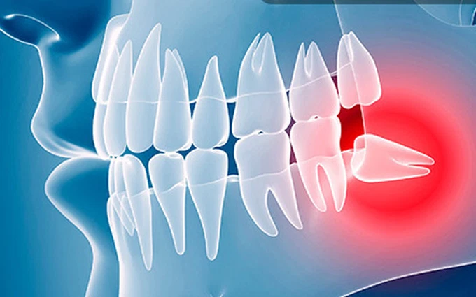 Nhổ răng khôn bao nhiêu tiền đối với răng khôn mọc gây đau nhức, ảnh hưởng cuộc sống