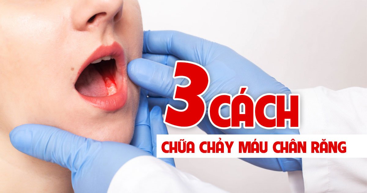 3 cách chữa chảy máu chân răng