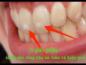 5 giải pháp chữa sâu răng nhẹ an toàn và hiệu quả