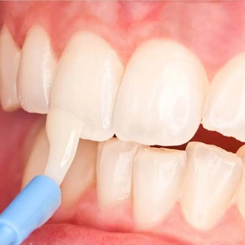 Chữa sâu răng nhẹ bằng phương pháp tái khoáng răng