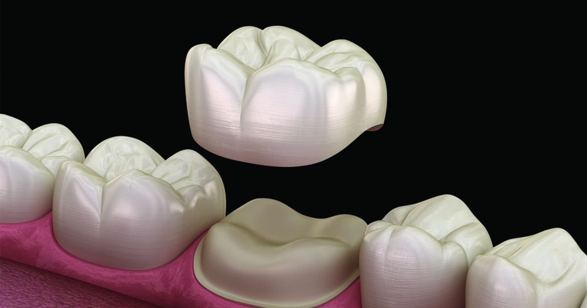 Cách chữa sâu răng hàm bằng phương pháp bọc sứ