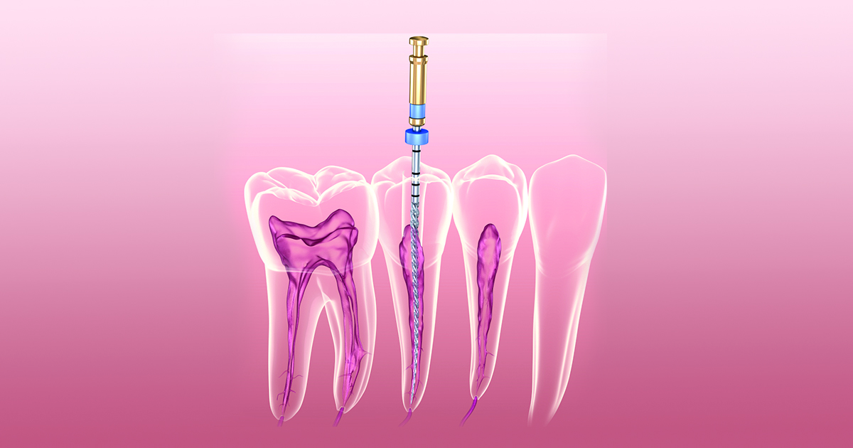 Cách chữa sâu răng hàm bằng phương pháp điều trị tủy