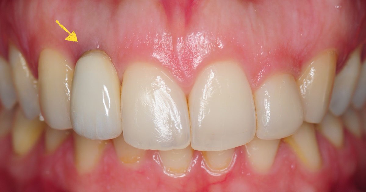 Tẩy trắng răng để hết chân răng bị đen, vết đen trên răng