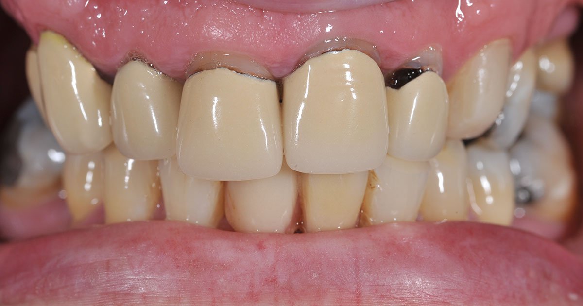 Chân răng bị đen có hết được không?