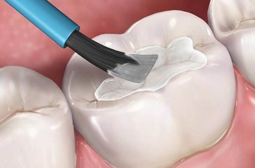 Chữa sâu răng nhẹ bằng phương pháp trám răng sâu