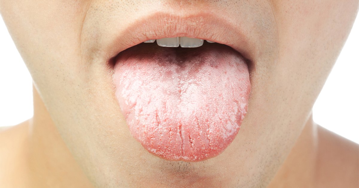 Lưỡi bị trắng dấu hiệu bệnh tiểu đường