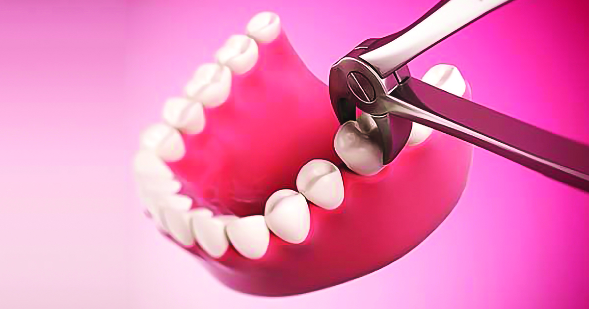 Cách chữa sâu răng hàm bằng phương pháp nhổ răng