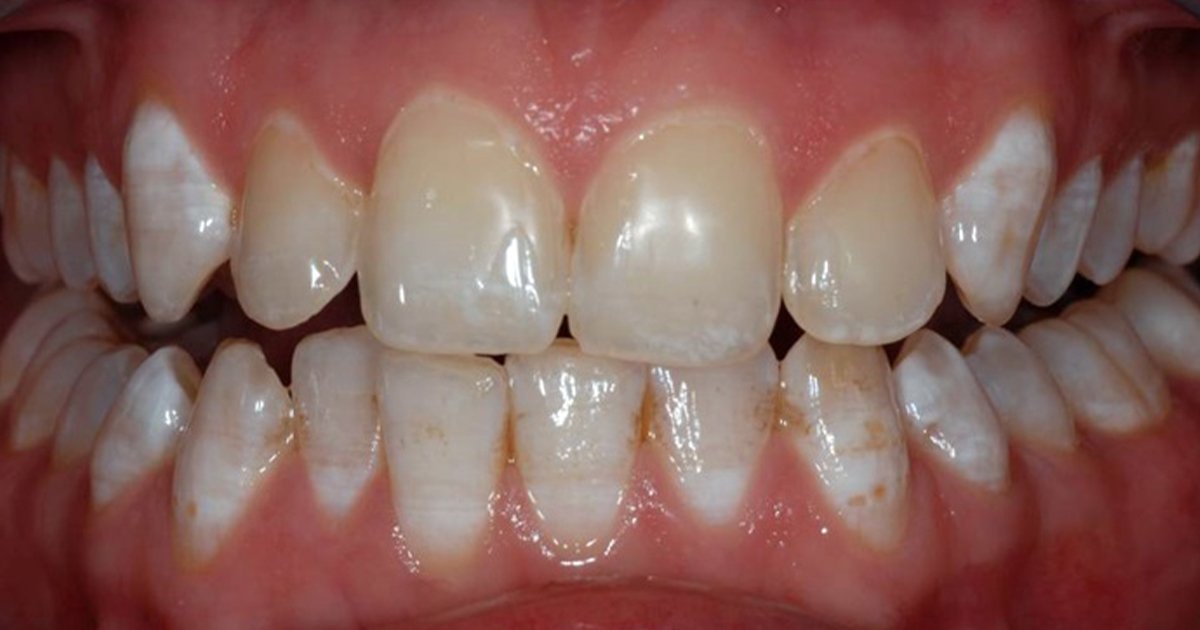 Tình trạng răng nhiễm fluor