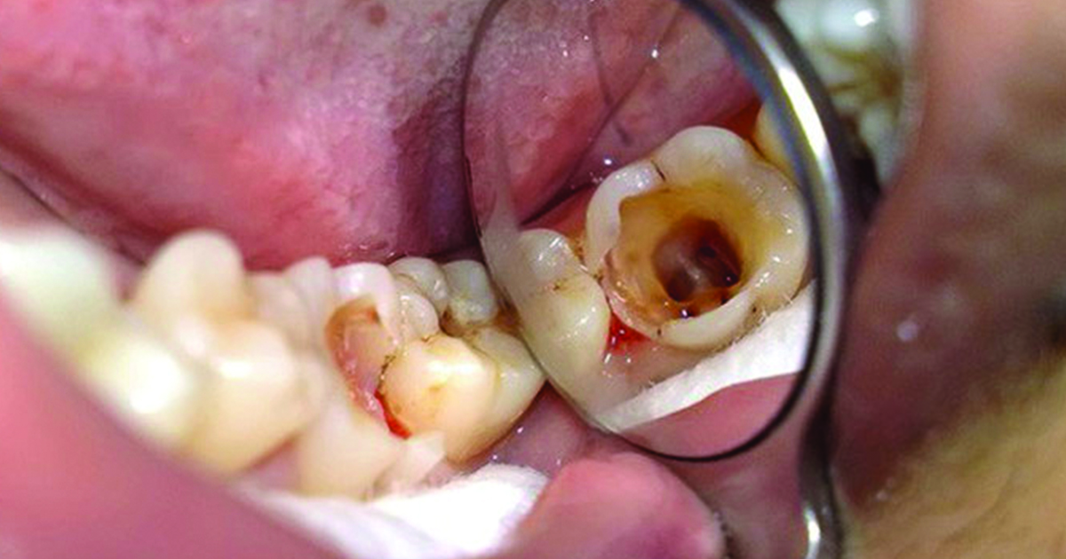 Cách chữa sâu răng hàm tùy theo các mức độ
