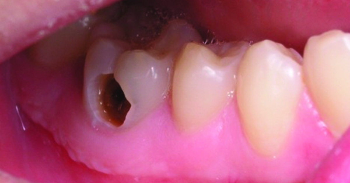 Cách chữa sâu răng hàm