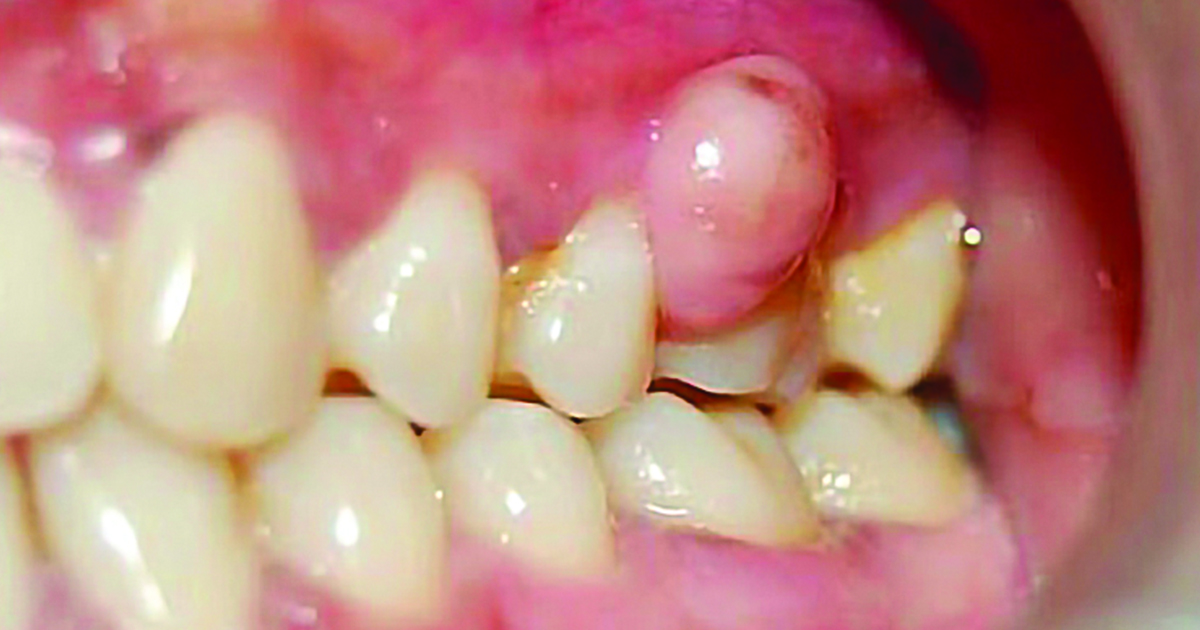 Sưng mộng răng có biểu hiện vùng nướu bị sưng tấy