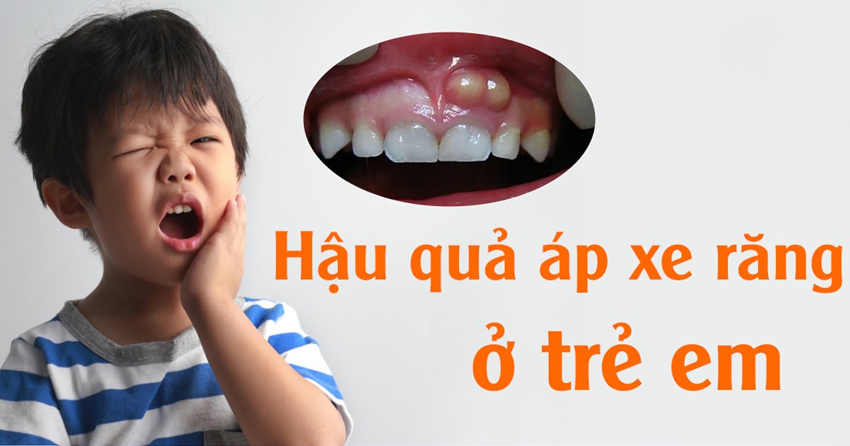 Hậu quả áp xe răng ở trẻ em