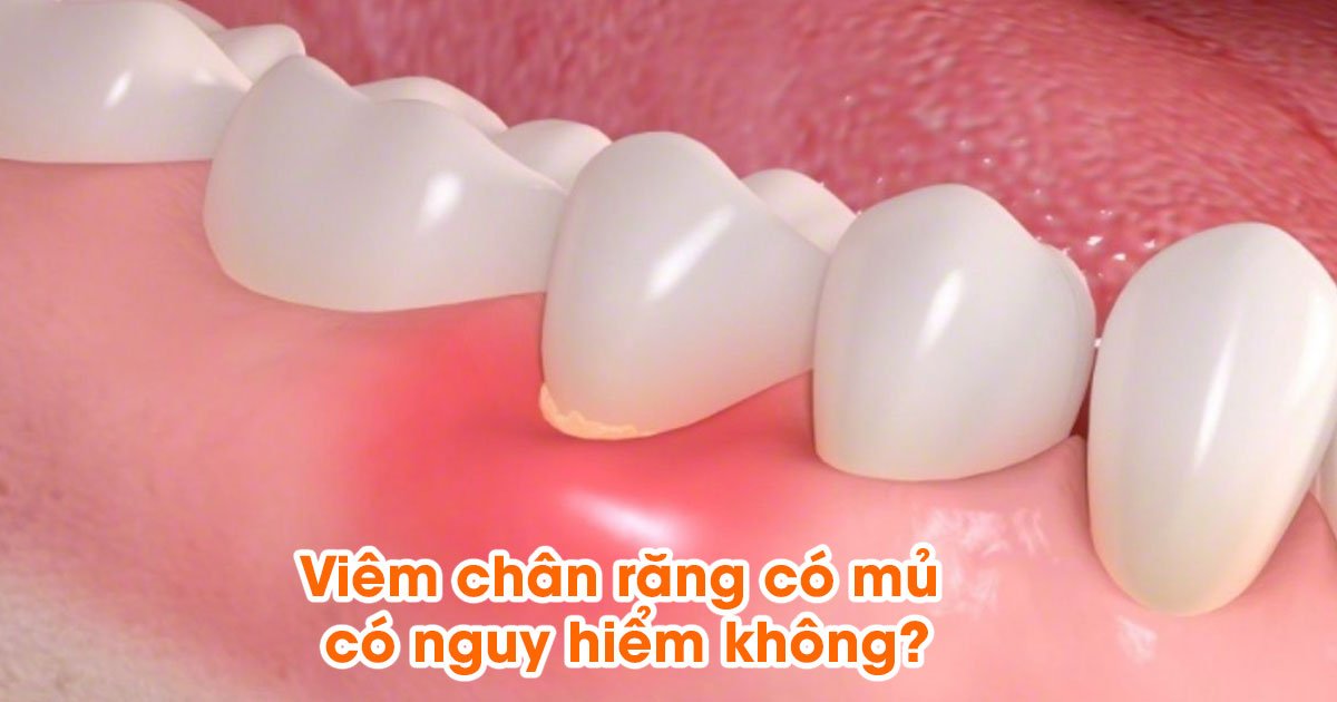 Viêm chân răng có mủ có nguy hiểm không?