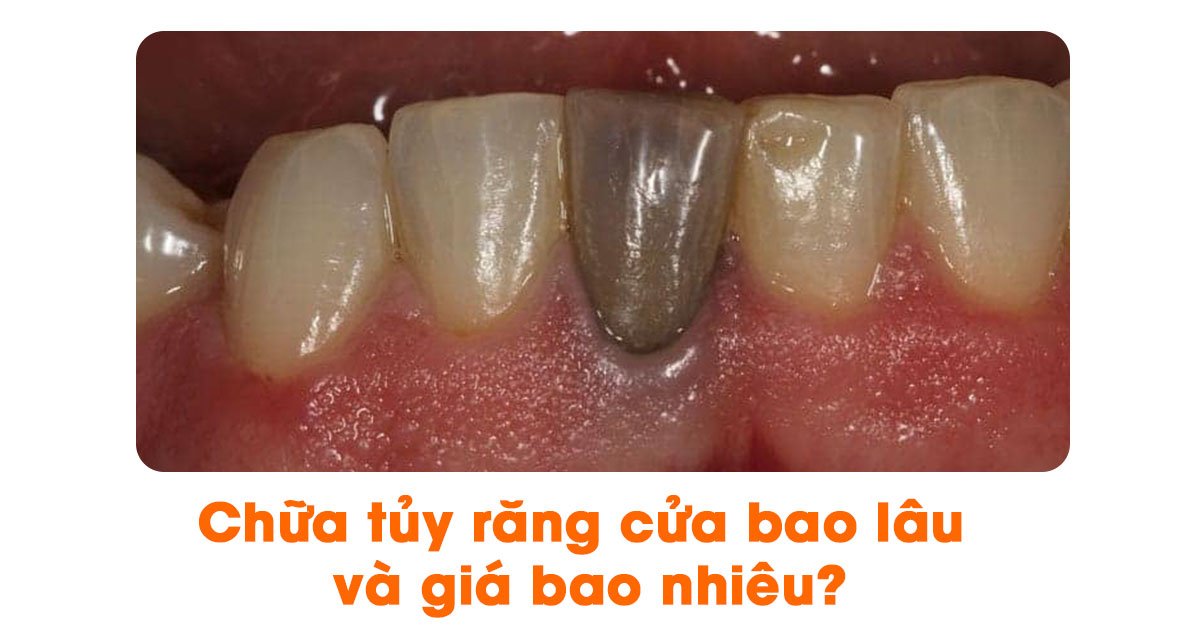 Chữa tủy răng cửa thời gian bao lâu và giá bao nhiêu?