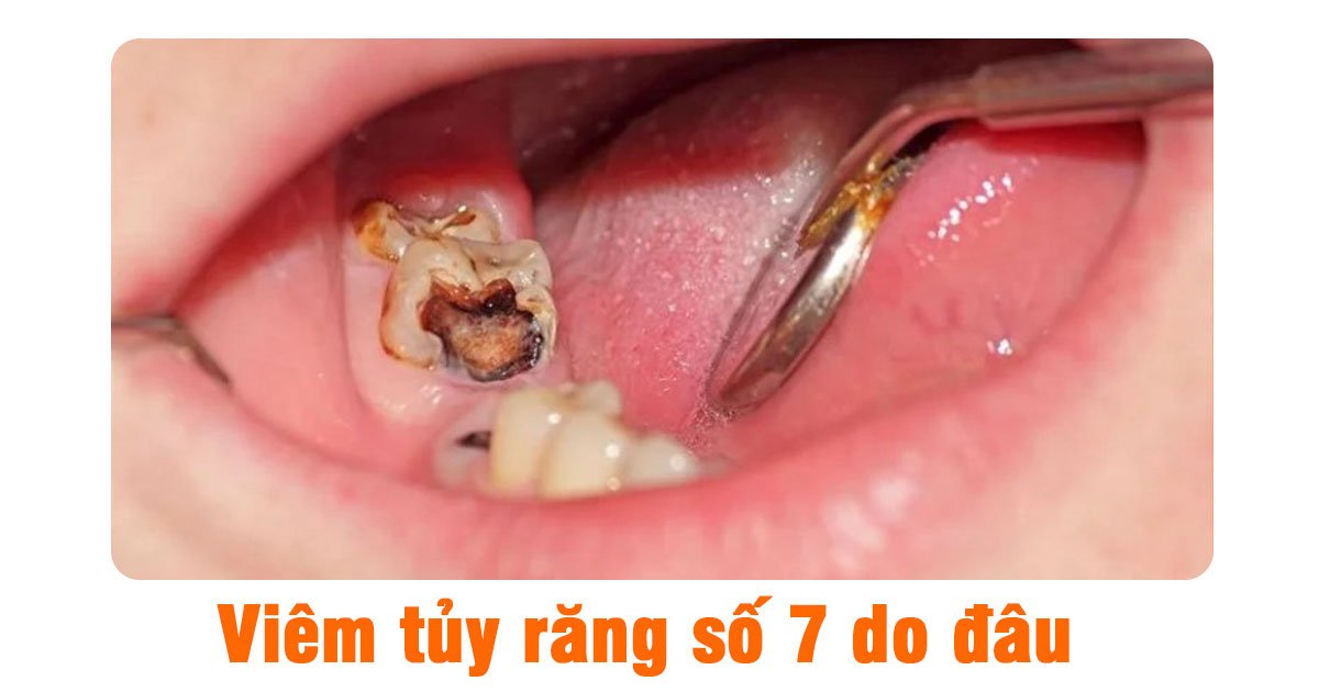Viêm tủy răng số 7 do đâu?