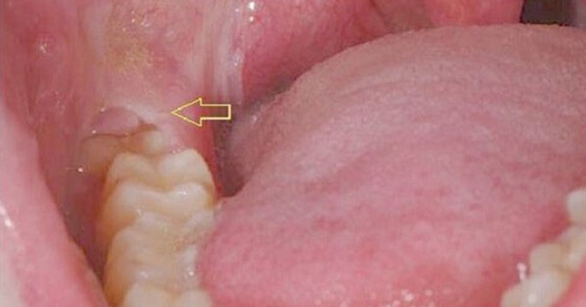 Top 3 cách khắc phục tình trạng cắn vào má trong 4 Răng khôn cắn vào má trong