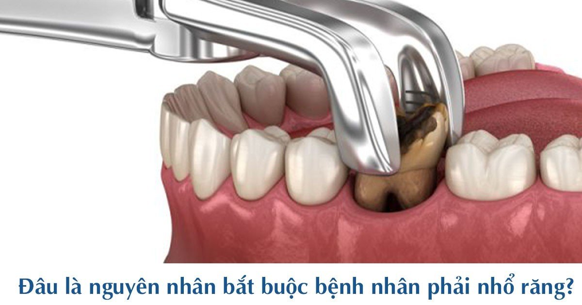 Đâu là nguyên nhân bắt buộc bệnh nhân phải nhổ răng?
