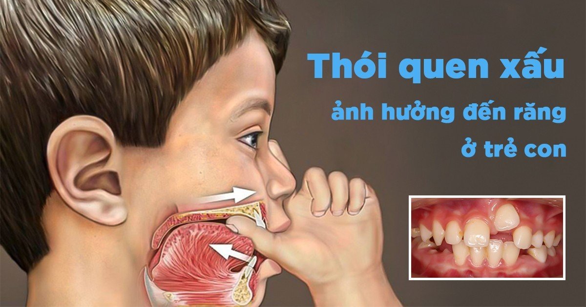 Mút tay, ngậm núm vú giả - thói quen xấu ảnh hưởng đến răng ở trẻ con