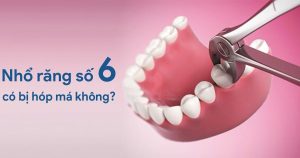 Nhổ răng số 6 có bị hóp má không?