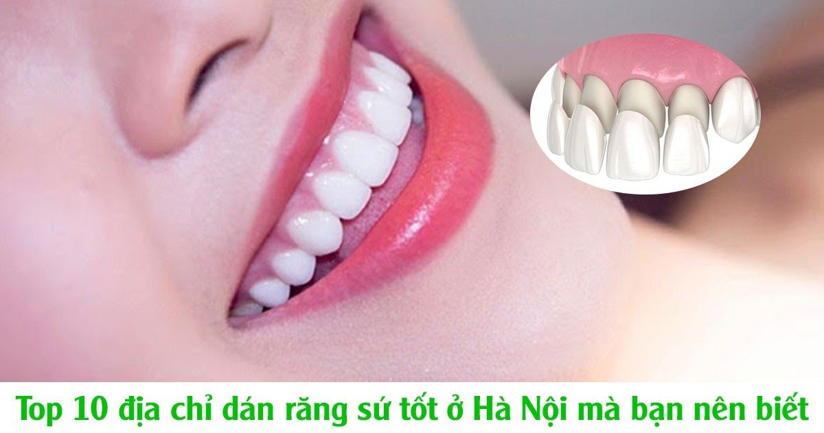 Top 10 địa chỉ dán răng sứ tốt ở hà nội mà bạn nên biết