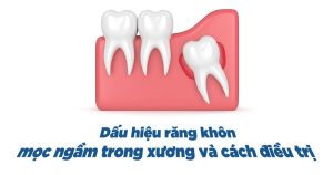 Dấu hiệu răng khôn mọc ngầm trong xương và cách điều trị