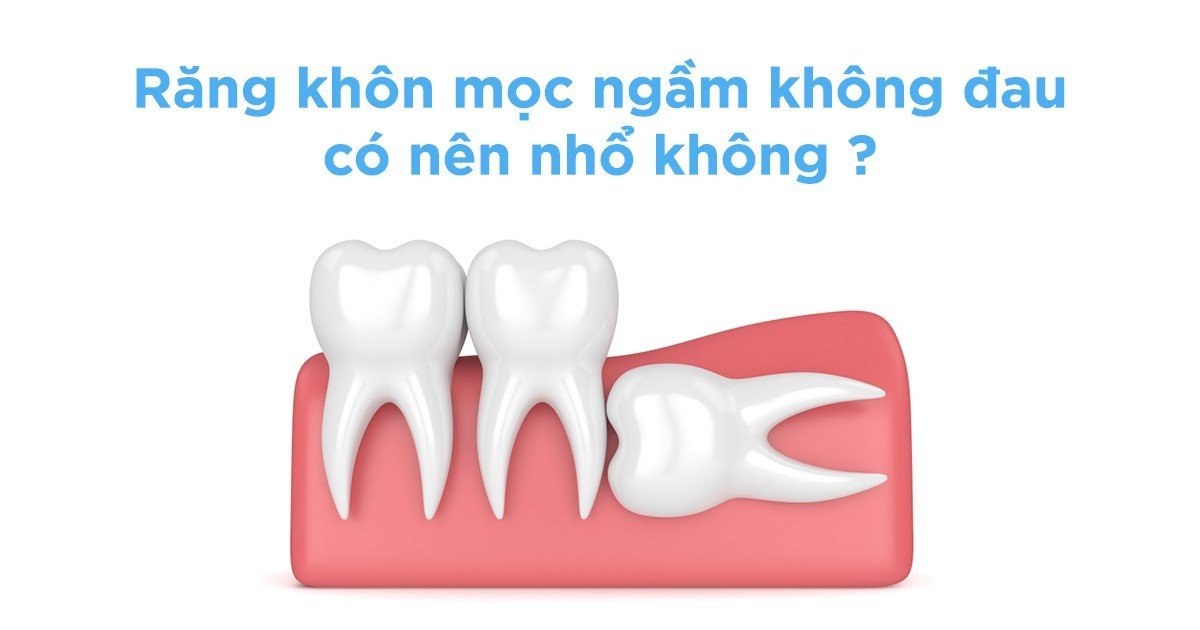 Răng khôn mọc ngầm không đau có nên nhổ?