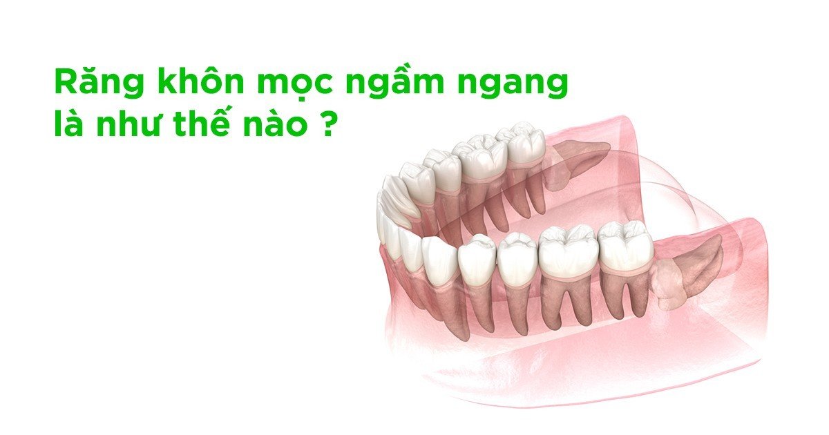 Răng khôn mọc ngầm trong xương gây tác hại như nào?