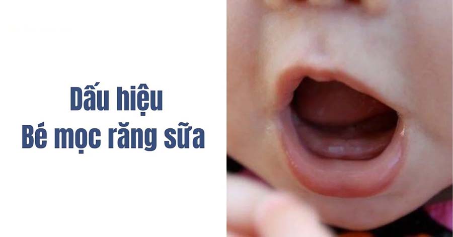Dấu hiệu mọc răng sớm của các bé