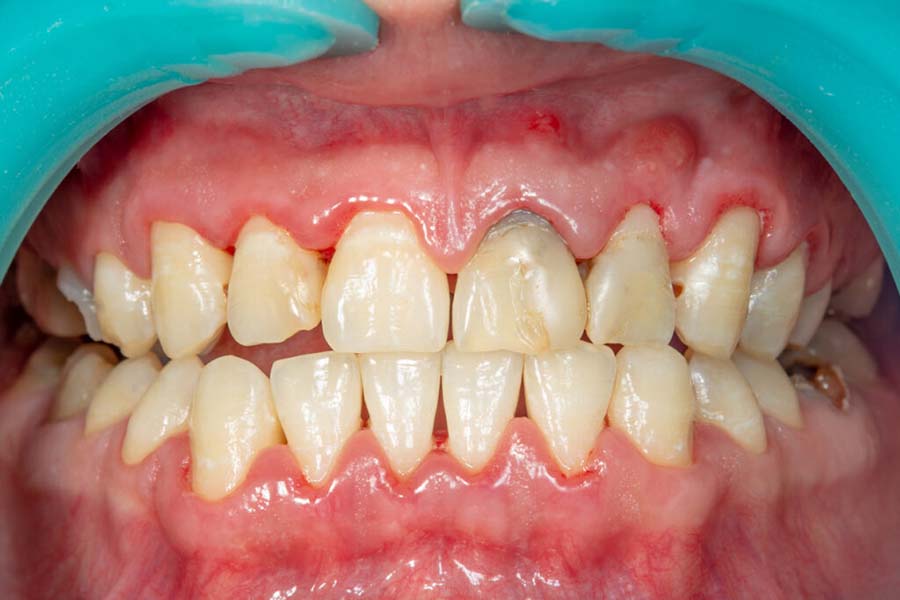 Điều trị viêm lợi chân răng