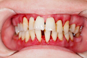 Hình ảnh viêm chân răng