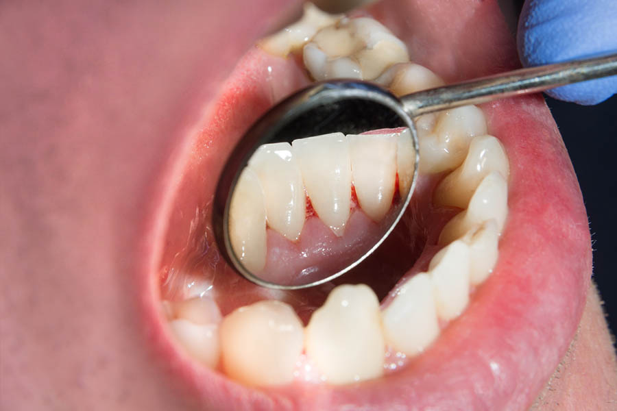 Hình ảnh viêm lợi chân răng