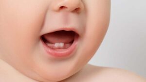 Trẻ mọc răng sớm có phải thừa canxi không