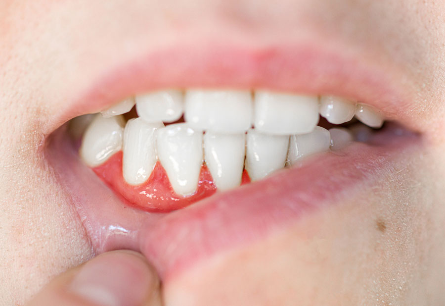Viêm lợi răng hàm dưới