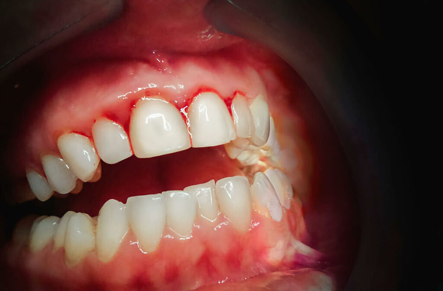 Viêm lợi răng là bệnh nguy hiểm