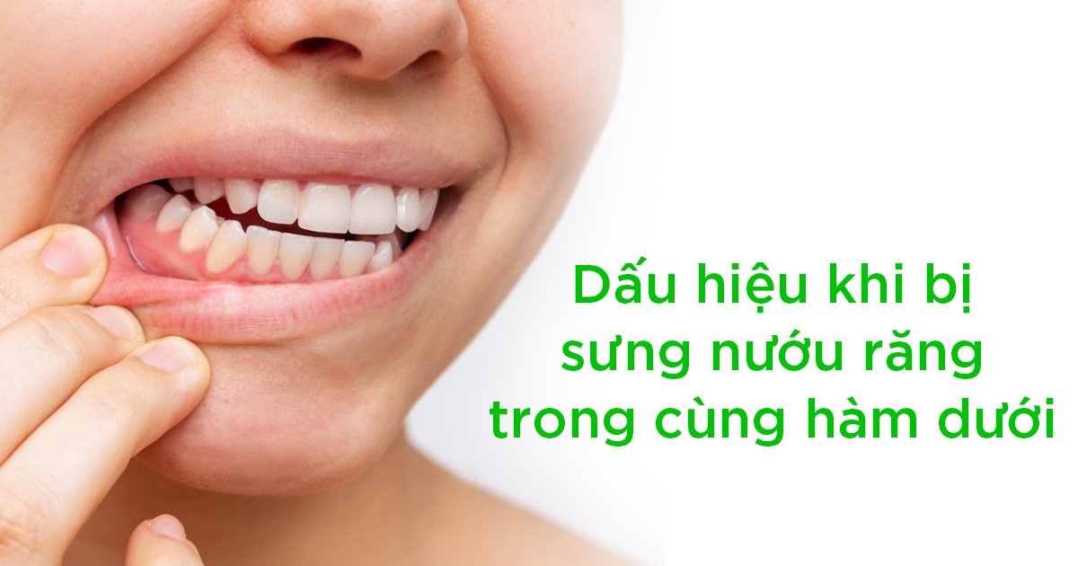 Dấu hiệu khi bị sưng nướu răng trong cùng hàm dưới