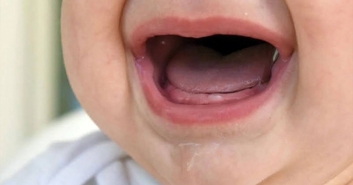 Hình ảnh lợi trẻ sắp mọc răng hàm - chảy nước dãi nhiều
