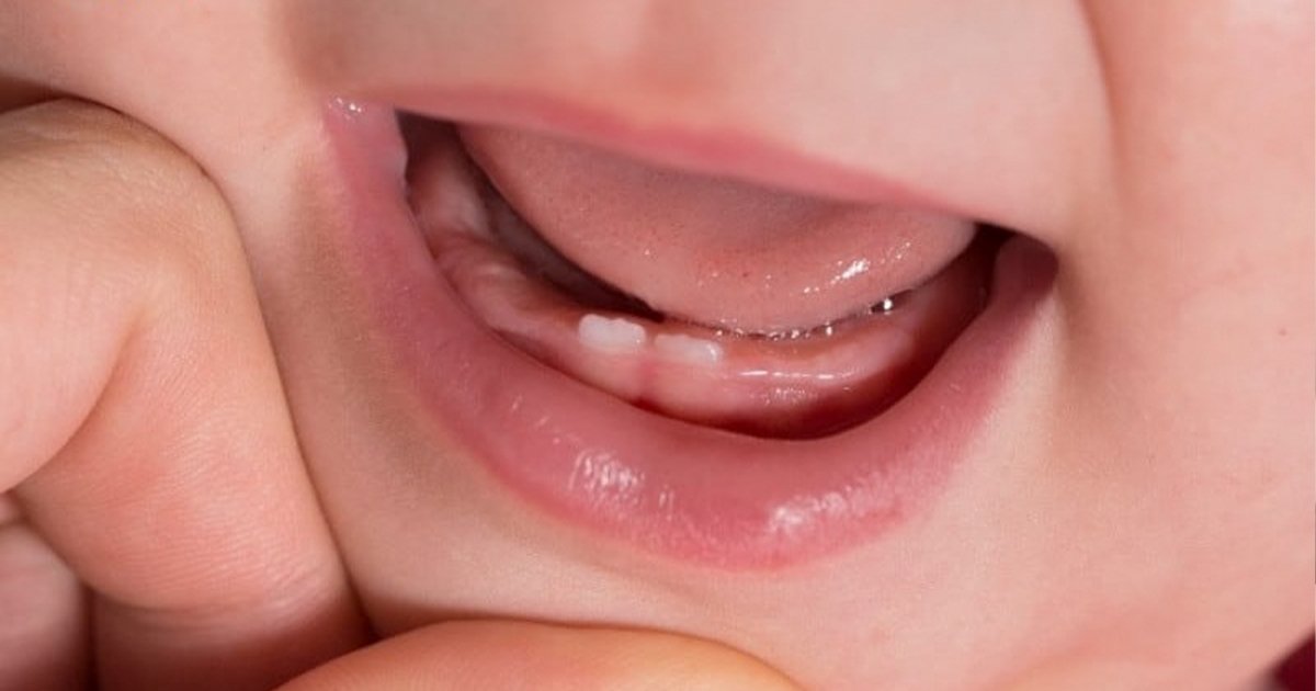 Hình ảnh lợi trẻ sắp mọc răng hàm - lợi sưng