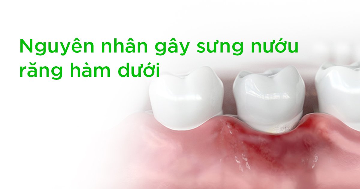 Nguyên nhân gây sưng nướu răng hàm dưới