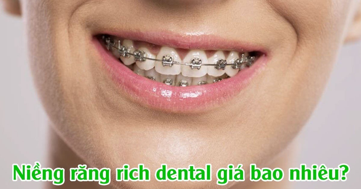 Niềng răng rich dental giá bao nhiêu?